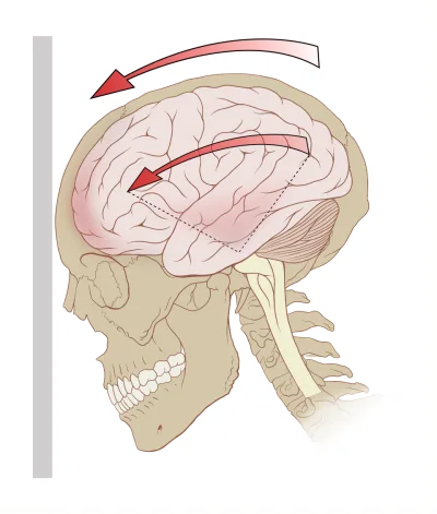 Concussed